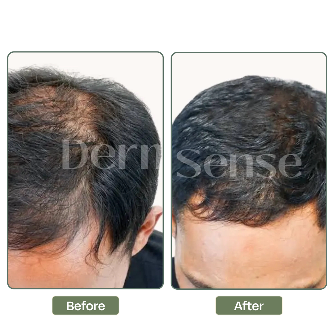 Hair loss treatment result