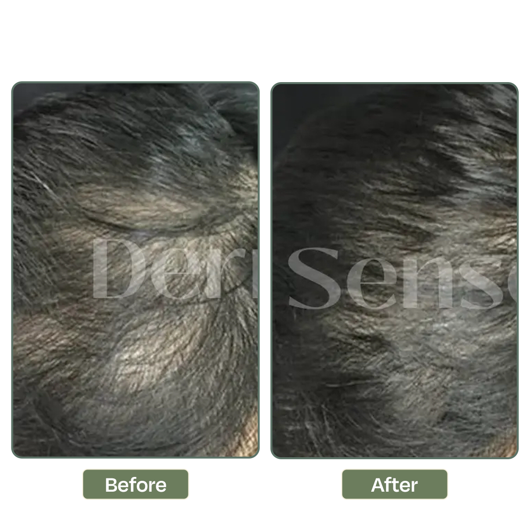 Hair loss treatment result