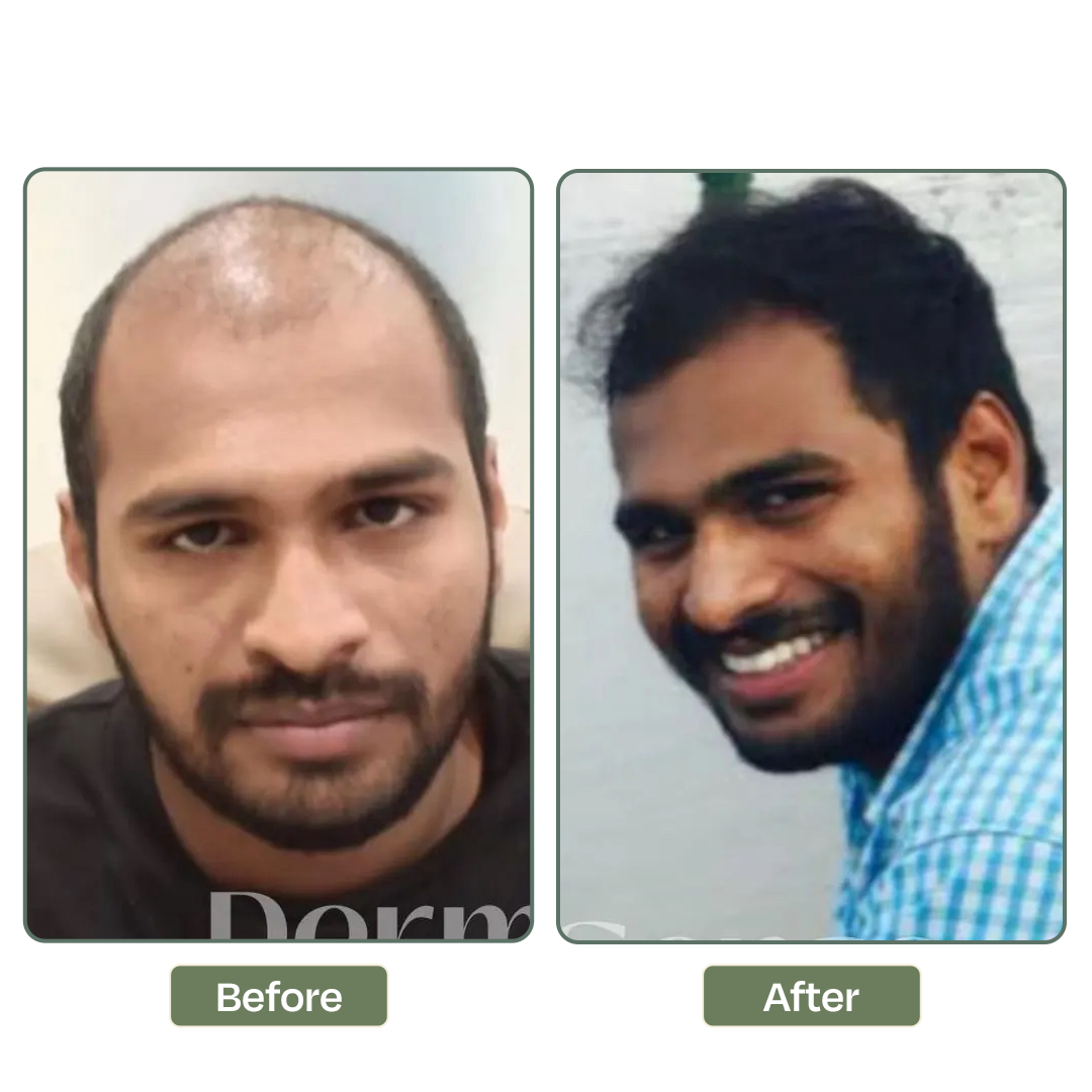 Hair loss treatment result