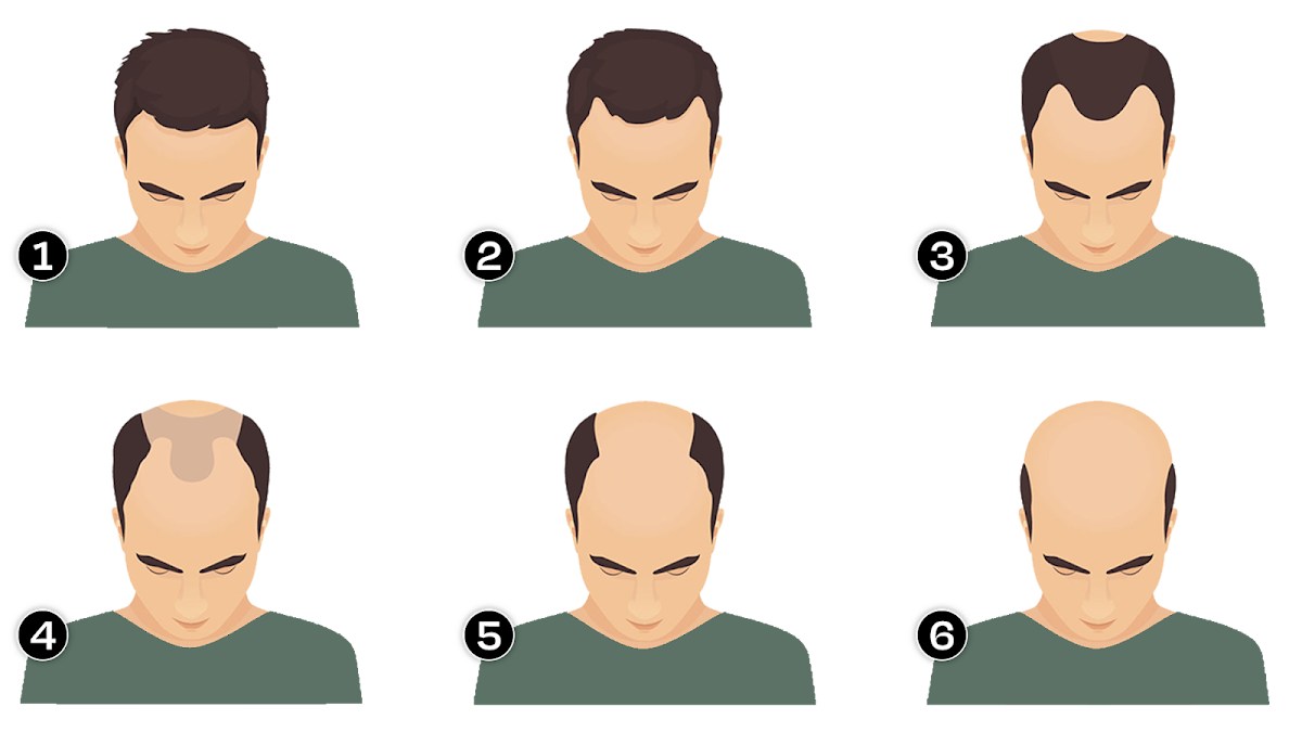 Stages Of Hair Loss In Men