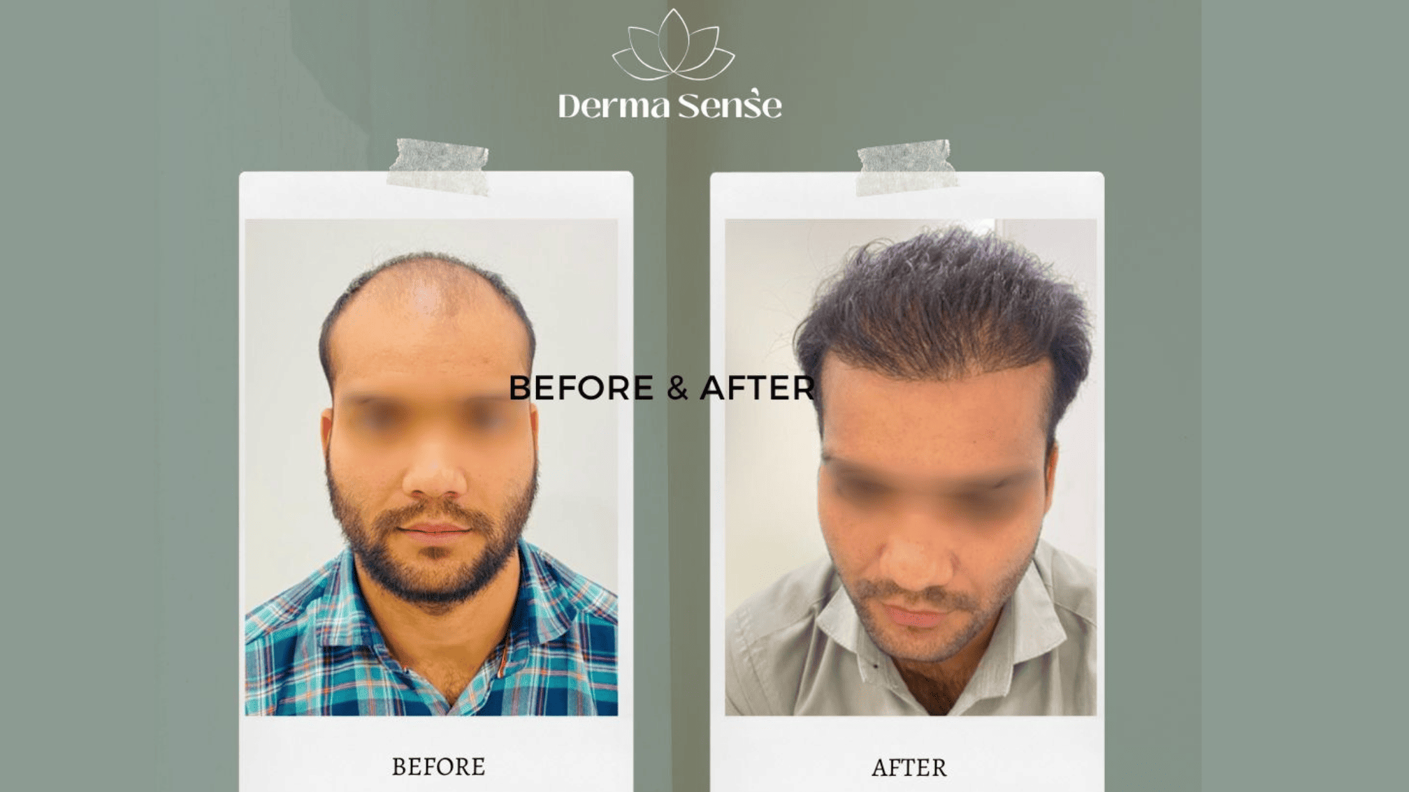 Hair transplant before and after