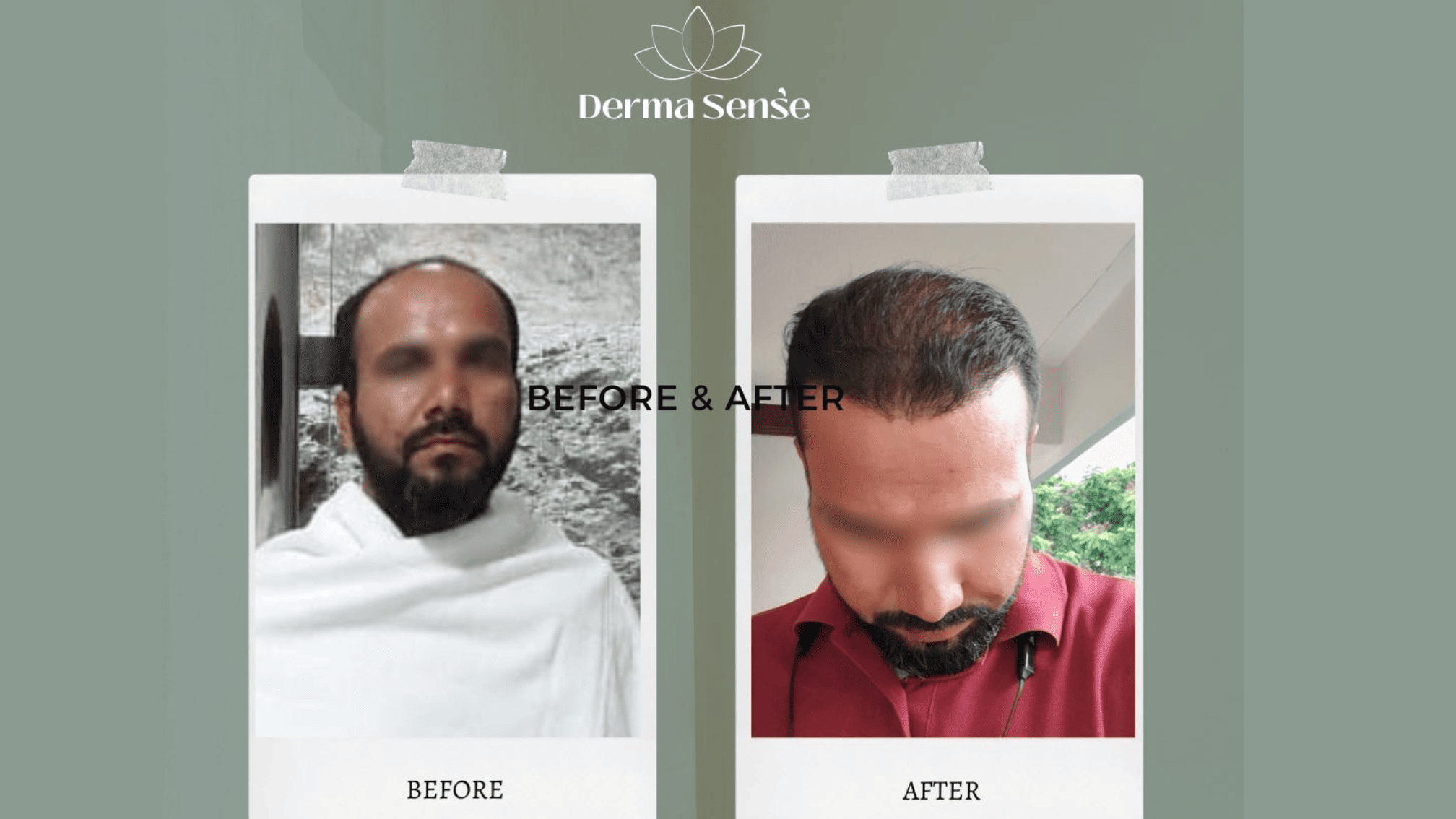 Hair transplant before and after