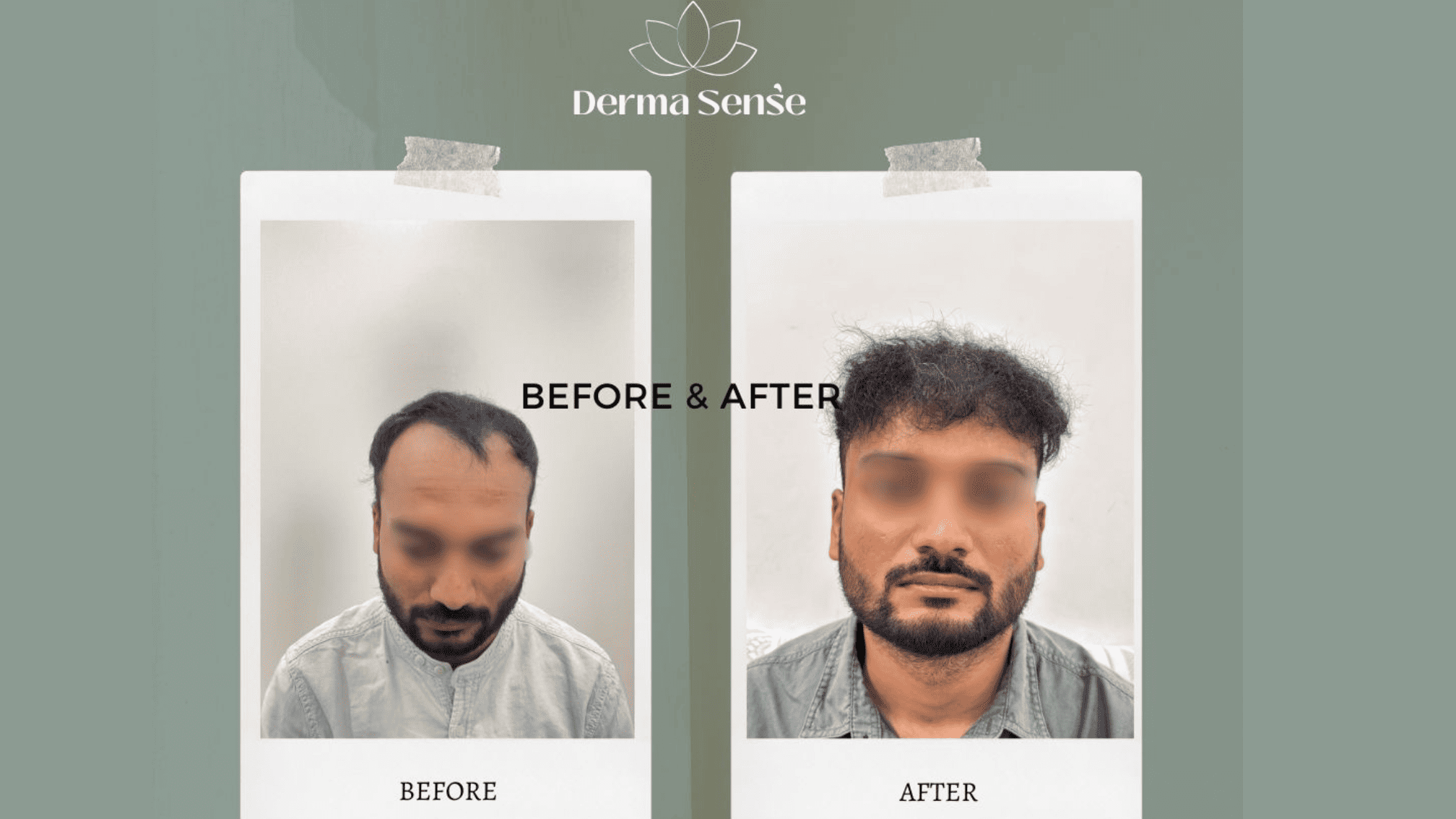 Hair transplant before and after