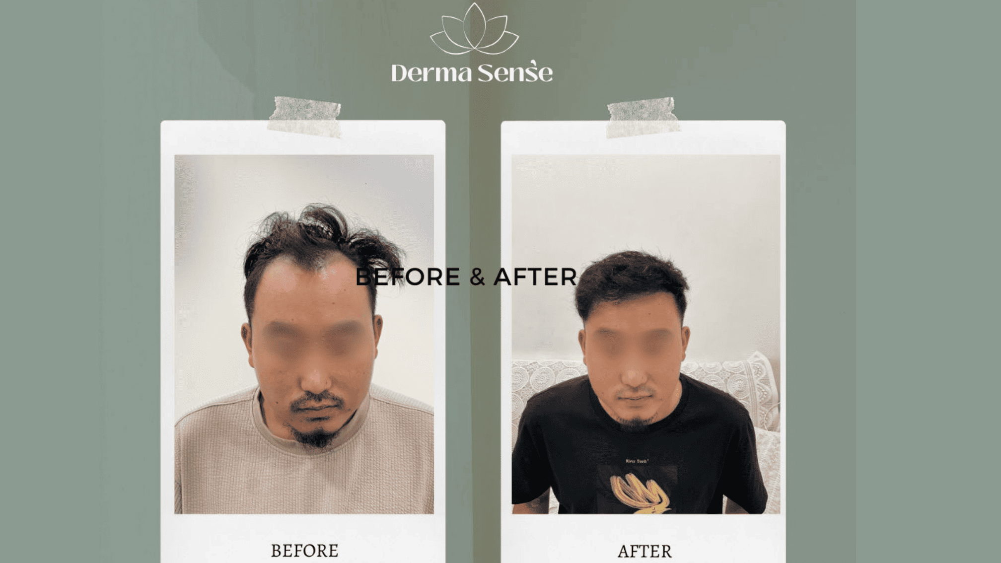 Hair transplant before and after