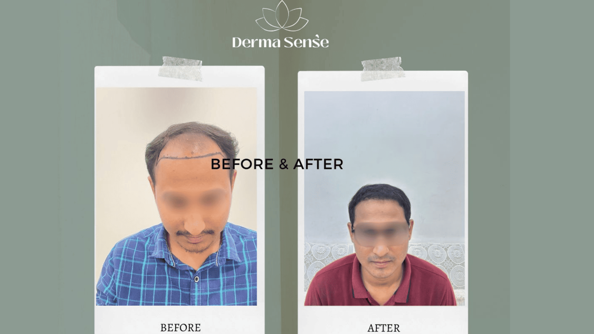 Hair transplant before and after