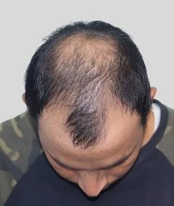 Hair transplant result