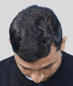 Hair transplant result