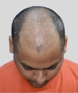 Hair transplant result