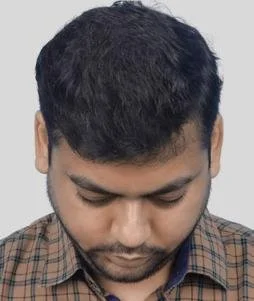 Hair transplant result