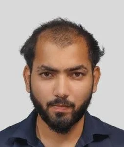 Hair transplant result